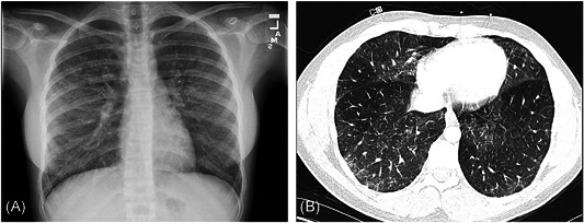 Examples of radiographic findings in two of our patients showing bilateral interstitial opacities. A, Anteroposterior radiograph; B, axial pulmonary CT angiography. CT, computed tomography