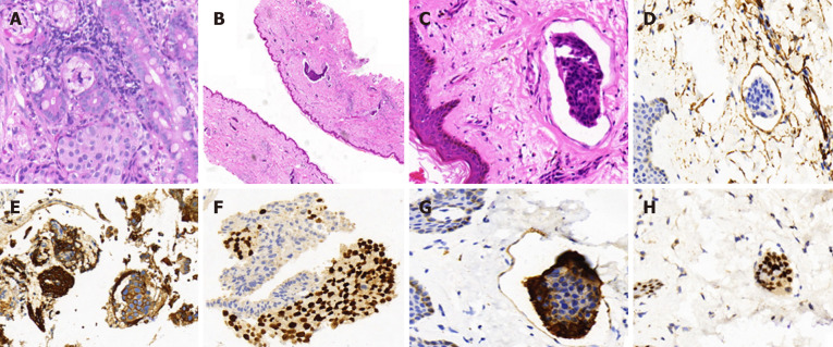 Histopathology of biopsies of the common bile duct and the skin of left neck and chest. A: Cancer cells were found to have infiltrated the glandular duct of the common bile duct (CBD); B and C: Low-power magnifications (B: 2´, C: 40´) demonstrating cancer embolus in the vasculature of the skin; D: Positive immunohistochemistry (IHC) staining for CD34 in the cancer embolus areas; E and F: Strong positive IHC staining for cytokeratin (CK) 7 and trans-acting T-cell-specific transcription factor (GATA-3) in the CBD; G: Strong positive IHC staining for CK7 in the skin of left neck and chest; H: Strong positive IHC staining for GATA3 in the skin of left neck and chest.