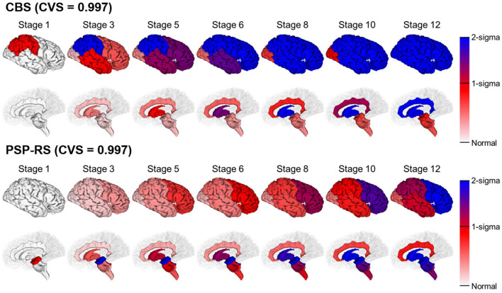 SuStaIn modeling of CBS and PSP-RS using regional brain volume data. Rows show the brain atrophy progression patterns of two subtypes estimated by SuStaIn. Each progression pattern was inferred as a sequential transition of individual subregions of gray matter volume from one z-score to another, relative to a control population. Colors at each stage and brain region indicate the severity of regional volume atrophy, where white signifies normal (z-score of 0, i.e., no atrophy), deepening to red indicates mild atrophy (z-score of 1), and deepening to blue indicates severe atrophy (z-score over 2).