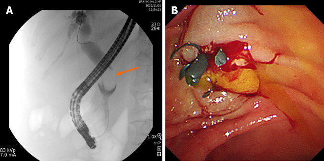 Endoscopic retrograde cholangiopancreatography was recommended and a biliary plastic stent was implanted for alleviating jaundice. A: Endoscopic retrograde cholangiopancreatography revealed a space-occupying lesion of the distal common bile duct; B: Endoscopic biliary plastic stent implantation.