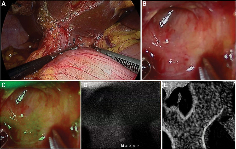 ICGF in a patient undergoing completion cholecystectomy. (a) Laparoscopic image in left upper corner showing a duodenal fistula to remnant and an obscure hepatocystic triangle; (b, c, d) Close up view of the hepatocystic triangle area in pure laparoscopy, NIRFA and NIRF modes respectively; E. Illustration of the NIRF image interpretation showing the location of common hepatic, CD and CBD. CBD = common bile duct, CD = cystic duct, ICGF = ICG fluorescence, NIRF = near-infrared fluorescence, NIRFA = near infrared fluorescence augmented.