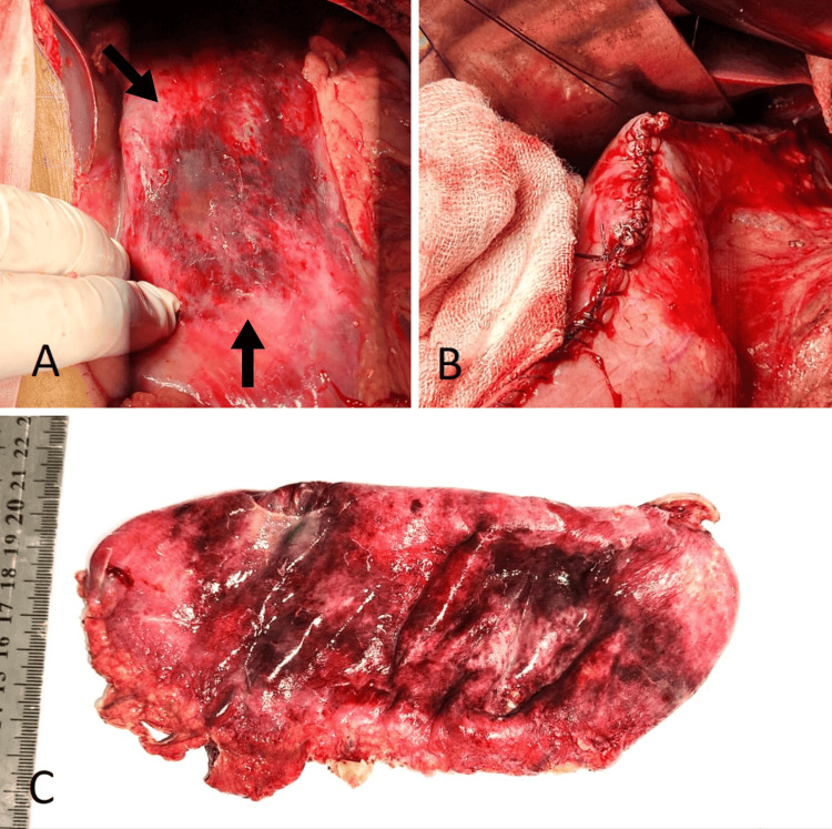Gross appearance of the stomachAn edematous stomach with patchy areas of necrosis of the anterior wall and along the greater curvature is evidenced by the arrows (A). Resection of the gangrenous portion of the stomach, followed by sleeve gastrectomy (B). Gross specimen after excision of the gangrenous portion and sleeve gastrectomy (C).
