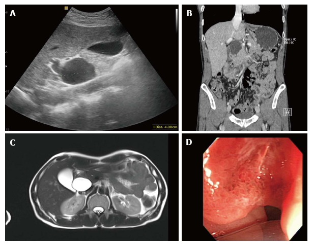 Evaluation of clinical findings. A: Ultrasonography of upper abdomen shows a 4.5 cm sized anechoic cystic mass adjacent to the head of the pancreas and common bile duct; B: Coronal multiplanar reformatted image of contrast-enhanced abdominal computed tomograph shows a homogeneous low-density cystic mass with thin, smooth walls abutting the common bile duct, with possible communication between the two structures; C: Axial T2-weighted magnetic resonance image demonstrates the cystic mass as a homogeneously high signal intensity lesion with thin walls, and there was no evidence of mural nodularity in the cystic mass; D: Endoscopic image of the duodenum shows irregular mucosal thickening with hyperemic change in the second portion of the duodenum.