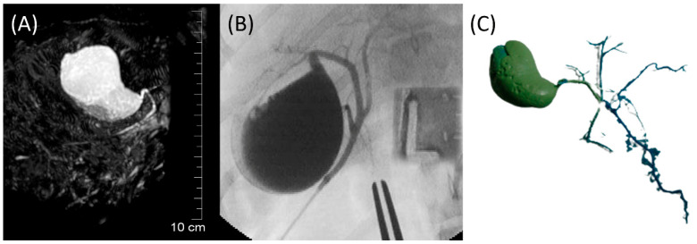 Images of Dog 6 with no evidence of biliary and pancreatic disorders. (A) 3D-TSE-MRCP image showing normal gallbladder, cystic duct, and common bile duct. (B) FRCP image demonstrating normal biliary tract filled with contrast material. (C) Corrosion cast demonstrating normal biliary tract.