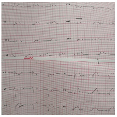 ECG shows ST segment elevation in leads V3-6, I, II and aVF