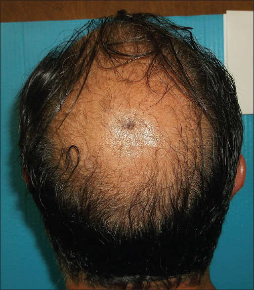 Male– Day 0–2 hairs/cm2
