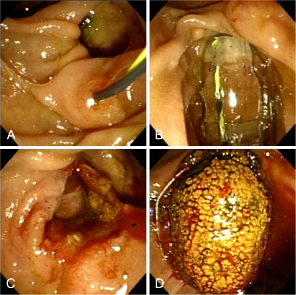 Endoscopic view of large-balloon dilation without biliary sphincterotomy. A. Guidewire positioned across the papilla. B. Large balloon inflated across the papilla without preceding endoscopic sphincterotomy. C. Markedly dilated papilla after large-balloon dilation. D. Large stone extracted with a basket through the dilated papilla.