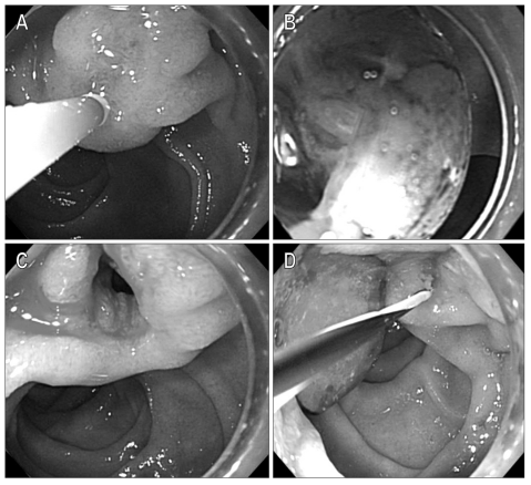 The consecutive steps for the removal of common bile duct (CBD) stones under cap-fitted, forward-viewing endoscopy. Following the selective cannulation of the CBD using a guidewire-preloaded papillotome (A), CRE balloon dilation (12 mm in diameter) was maintained for 60 seconds (B). After dilating the major duodenal papilla, a large opening was noted (C), and the stones were removed by a retrieval balloon and mechanical lithotripter (D).