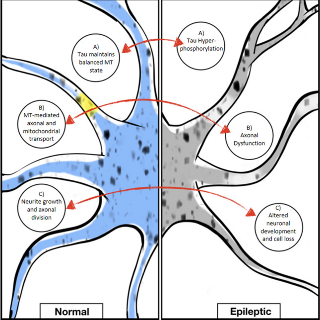 Schematic representation of the main targets implicated in microtubule-mediated actions in normal versus epileptic neurons. (A) In epileptic neurons, it was found tau in hyper-phosphorylated state which is linked to aberrant network organization, whereas in normal neurons tau contributes to balanced microtubule (MT) state and proper functioning. (B) In epileptic neurons, axonal dysfunctions are found, whereas in normal neurons microtubule-mediated axonal and mitochondrial transport are maintained. (C) In epileptic states, microtubules are implicated in altered neuronal development, eventually leading to neuronal loss, whereas in normal neurons MT contribute to proper neurite growth and axonal division