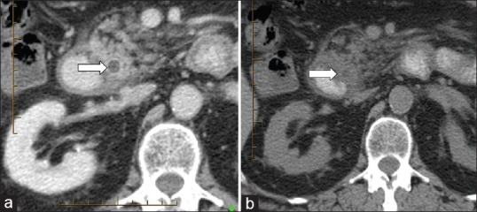 A 63-year-old man with acute pancreatitis. The images are of transverse MDCT with positive intraduodenal contrast filling. (a) On this IV contrast-enhanced acquisition, only one observer successfully detected an ERCP-proven distal CBD stone appearing as a rim-sign (straight arrow). (b) The stone was otherwise obscured on the unenhanced CT acquisition (straight arrow)