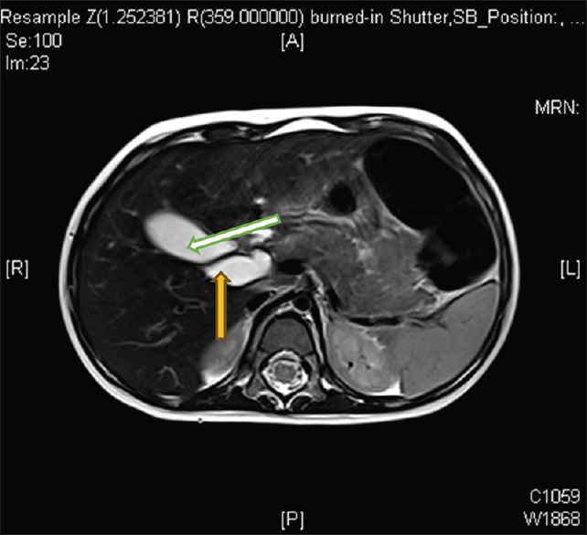 Magnetic resonance cholangiopancreatography T2-weighted axial cut showing dilated cystic duct 10 mm (white arrow) and common bile duct 7.5 mm (yellow arrow)