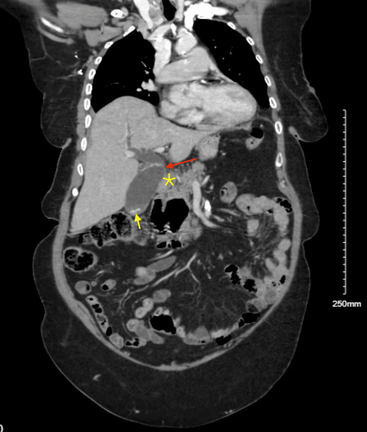 Distended common bile duct and gallbladder (red arrow), choledocholithiasis and cholelithiasis (yellow arrow), and possible obstruction at pancreatic head (yellow star).