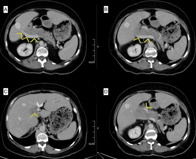 Computed tomography images showing the aberrant anatomy of the second portal vein (yellow arrows) traveling behind the pancreas and entering the liver near segment VI (A, B), a stone in the common bile duct (yellow arrow) next to the original portal vein (white double arrows) at the level of the porta hepatis (C), and the original portal vein (yellow arrow) coursing anterior to the pancreas (D).
