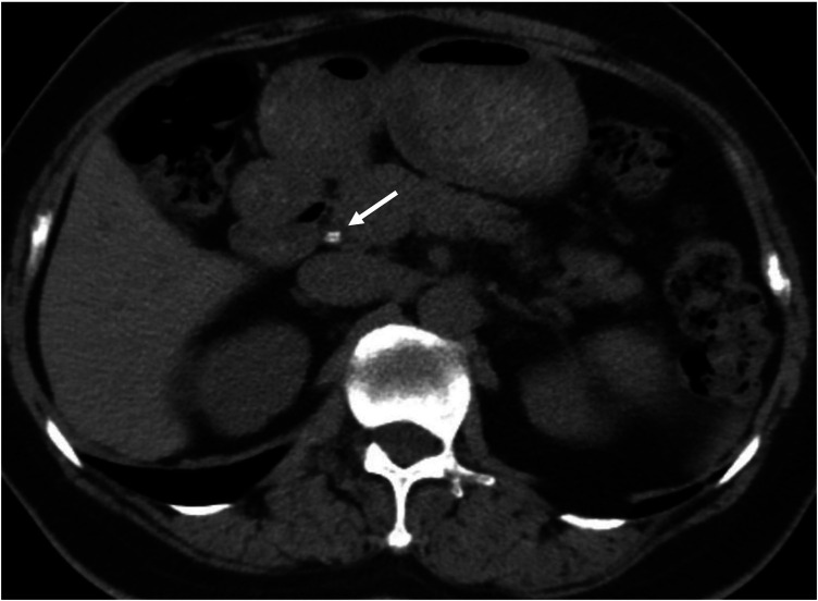 Axial view of a non-contrast abdominal CT scan obtained on patient admission. The image displays upper abdominal anatomical structures including the biliary tract, liver, and pancreas. A white arrow clearly indicates radiopaque stones within the common bile duct. No pneumobilia is observed in the intrahepatic or extrahepatic bile ducts, with no abnormal lesions in the adjacent soft tissues.