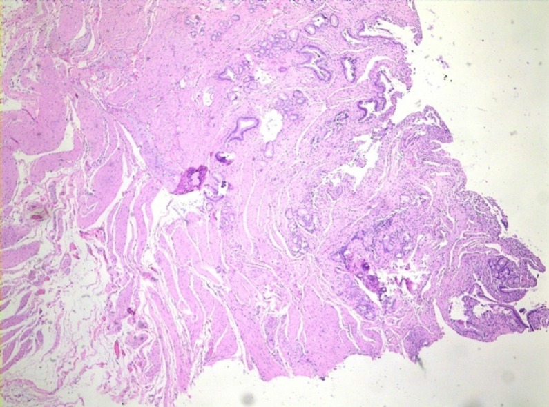 Histological findings from our case. The histological features of the resected mass arehyperplastic glandular lobules were surrounded by hyperplastic muscle fibers, fibroblasts, and myofibroblasts (Hematoxylin and eosin staining, ×200 magnification).