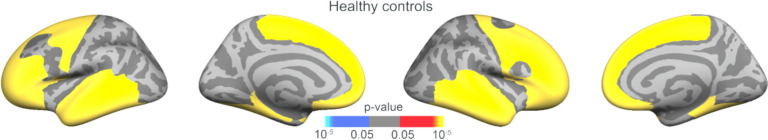 Corrected correlation maps between surface area and intracranial volume (ICV) for healthy participants using a frontal–temporal mask. Multiple comparison correction was performed using permutation testing of 100,000 tests with a cluster-forming threshold of p < .05 and cluster-wise threshold of p < .05 using a frontal–temporal mask with additional Bonferroni correction to take both hemispheres into account. (Orange colour = positive correlation between surface area and ICV)