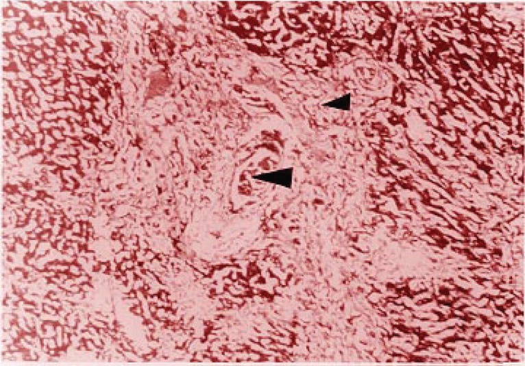Cholangiolar biliary thrombosis (large arrow) associated to irregular fibrosis augmented in the portal area that involves the lobule (small arrow), mainly centrally located.