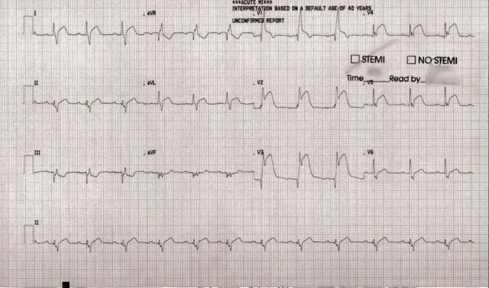 Emergent Electrocardiography Revealed Right Bundle Branch Block and Significant ST-Segment Elevations in the Anterior Leads (V2-V5), Indicating Acute Myocardial Infarction in the Left Anterior Descending Coronary Artery TerritorySTEMI = ST-segment elevation myocardial infarction.