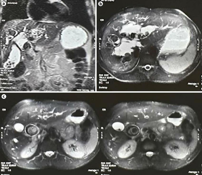 Magnetic resonance cholangiopancreatography. a Coronal view showing giant calculus within choledochal cyst with cholelithiasis. b Axial image demonstrates intrahepatic choledochal cysts with multiple filling defects within calculi. c Axial view shows giant calculus within choledochal cyst with prominent bilateral intrahepatic biliary radicals (choledochal cysts).