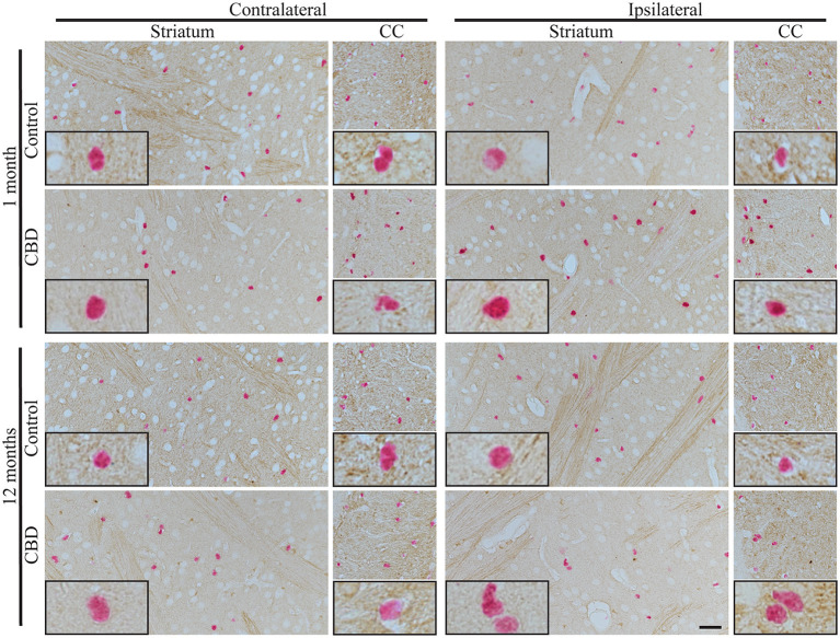 The absence of tau pathology transmission in astrocytes. The microphotography pictures of double immunohistochemistry staining of tau phosphorylated at Ser202 (CP13 antibody, brown chromogen) in astrocytes (Sox9, nuclear marker, red/pink chromogen). The cell distribution in the contralateral (left panel) and ipsilateral side (right panel) of striatum (left subpanel) and corpus callous (right subpanel) after 1 month (upper panel) and 12 months (lower panel) of control-tau (upper subpanel) or CBD-tau (lower sub panel) inoculation. The representative pictures of cells in each group are presented as black-bordered inserts and demonstrate the absence of pathological tau in astrocytes in any of the experimental group at any time points, and similarly, the absence of pathological tau in neurons (morphological cell distinction) in any of the experimental group at any time points. The scale bar represents 50 μm and applies to all pictures; the black-bordered inserts represent 4× digital enlargement.