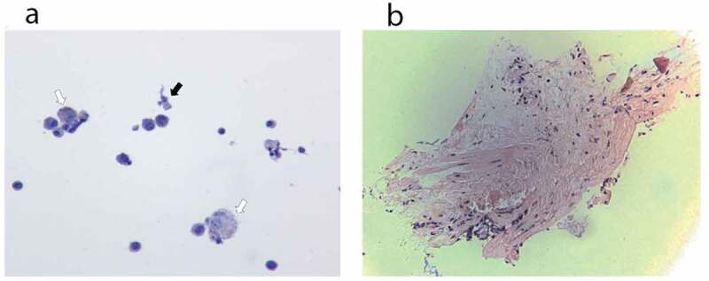 Histopathology. (a) Cytology from bronchoalveolar lavage fluid of case 1. The hollow arrows point to few non-vacuolated foamy macrophages, without droplet deposition. The black arrow points to one bronchial cell. (b) Pathology from lung biopsy of case 1. Minimal tissue. There is no alveolar damage observed