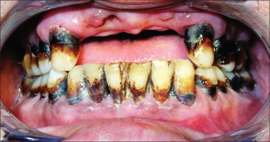 Generalized cervical caries with generalized periodontitis in a 48-year-old patient smoked cannabis for 17 years