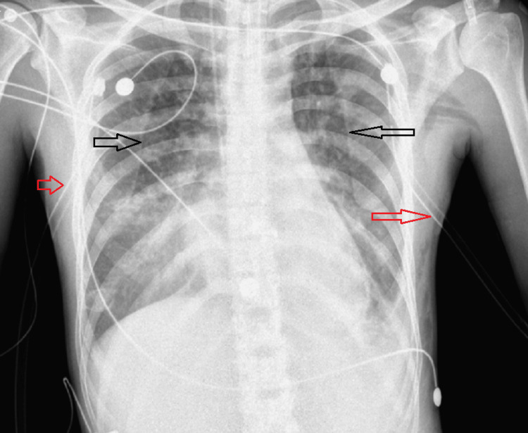 CXR with bilateral pneumothorax and chest tubesBlack arrows point to the pneumothorax and red arrows point to the chest tubes.CXR: chest X-ray