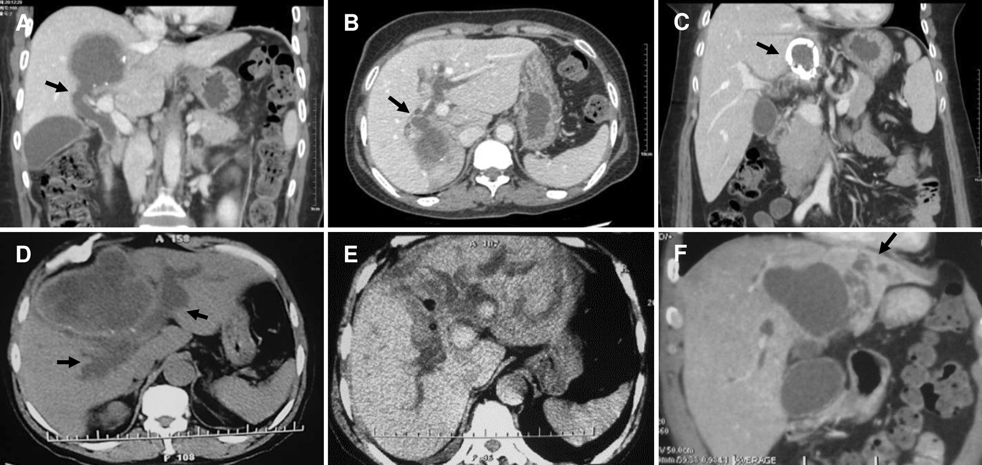 CT presentations of frank cysto-biliary communications. a Cysto-biliary communication (arrow) at right supra section and debris-filled common bile duct; b Cysto-biliary communication (arrow) at right posterior lobe; c Capsule calcified cyst (arrow) interlinking with left hepatic duct; d Medial lobular cyst presenting cysto-biliary communication to major hepatic ducts form both sides (arrows); e Severe left lateral lobe liver damage caused by cysto-biliary communication; f Hepato-atrophy (arrow) of left lateral lobe led by cysto-biliary communication