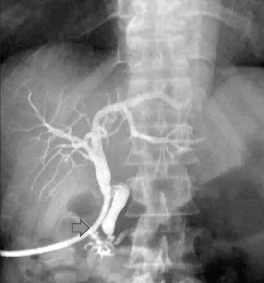Cholangiogram performed through percutaneous transhepatic biliary drainage catheter (PTBD catheter, arrow) following balloon dilatation of stricture reveals good opacification of the entire biliary tree