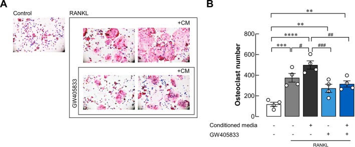 GW405833 suppressed osteoclastogenic effects from MDA‐MB‐231‐derived conditioned media. (A) Representative images of TRAP staining in RANKL‐primed RAW264.7 cells treated with 10% MDA‐MB‐231‐derived CM, GW405833, or both, with and without RANKL exposure (B) quantifies the number of osteoclasts containing at least three nuclei from the experiments depicted in (A). The results were expressed as mean ± SEM of four independent biological replicates. (**p < 0.01, ***p < 0.001, ****p < 0.0001, #p < 0.05, ##p < 0.01, ###p < 0.001).