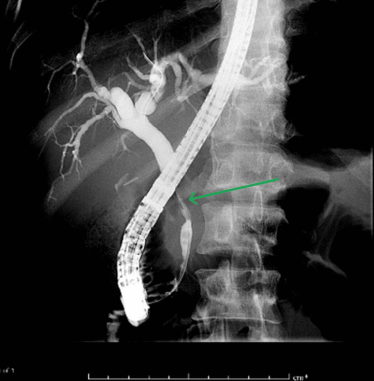 ERCP demonstrating biliary narrowingEndoscopic retrograde cholangiopancreatography (ERCP) shows a narrowing of the mid common bile duct (CBD) (green arrow) with associated obstruction and upstream dilatation of the hepatic biliary ducts.