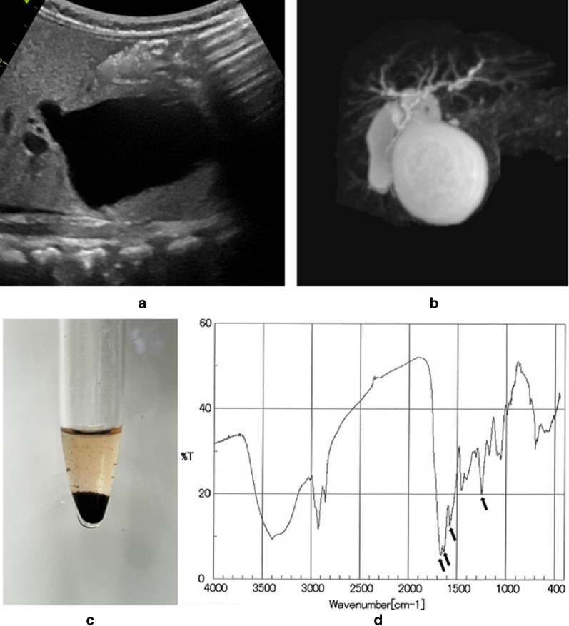 Data of Case 2. a Ultrasonography detected debris in the cyst. b Magnetic resonance imaging showed a cyst of the common bile duct. c The sludge in the bile duct consisted of fine black particles. d Infrared absorption spectra of the debris. Four major absorption bands (arrows) were characteristic of calcium bilirubinate