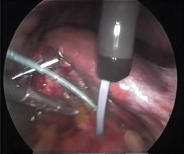Common bile duct exploration using upper GI endoscope