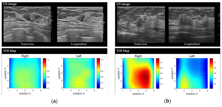 Representative images of benign and malignant breast lesions derived from the discrete multi-wavelength near-infrared spectrum (DMW-NIRS) imaging. (a) Conventional US image and Tissue Optical Index (TOI) map of a 9 mm mass in the left breast, located at the 2 o’clock position, 3 cm from the nipple, in a 50-year-old woman. The initial Breast Imaging Reporting and Data System (BI-RADS) category assessment by a breast-dedicated radiologist was 4A. The TOIL/N ratio was 1.0544, below the threshold of 1.1862. A core needle biopsy revealed fibroadenomatoid hyperplasia. (b) Conventional US image and TOI map of a 13 mm mass in the right breast, located at the 10 o’clock position, 6 cm from the nipple, in a 53-year-old woman. The initial BI-RADS category assessment by a breast-dedicated radiologist was 4C. The TOIL/N ratio was 1.5365, exceeding the threshold of 1.1862. A core needle biopsy confirmed invasive lobular carcinoma.
