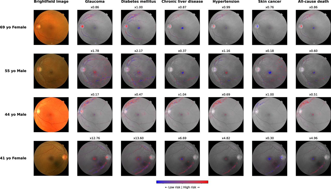 Image attributions characterise the predictive information in the retinaImage attributions for six selected endpoints and four individuals were derived via information bottleneck attribution (IBA) against the retinal state adjusted by age and biological sex. Regions with attributions to increased risk are highlighted in red, while regions with attribution to decreased risk are highlighted in blue. The colour intensity corresponds to the strength of attribution.