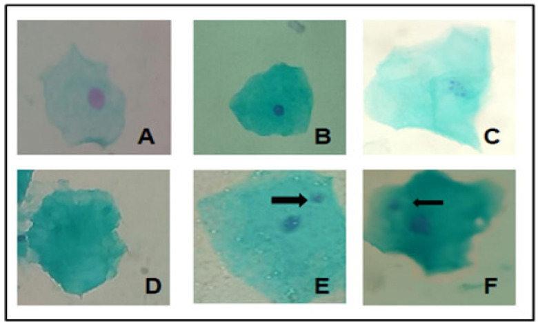 Photomicrography of Oral Mucosa Cells Cells Showing Metanuclear Changes. (A), Normal cell; (B), Pyknosis; (C), Karyorrhexis; (D), Karyolysis; E and F, Micronucleus (arrow). Feulgen-Fast green staining. X100 magnification