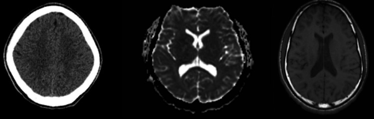 (Left) Non-contrast CT brain showing no evidence of acute intracranial hemorrhage, mass effect, midline shift, or hydrocephalus.(Center) MRI brain without contrast demonstrating normal parenchymal signal intensity on T1- and T2-weighted sequences, with no signs of acute infarct, mass lesion, or demyelinating process. (Right) MRI brain with contrast showing no abnormal enhancement.