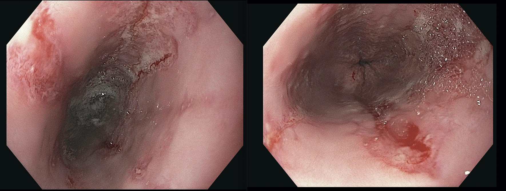 Images of the esophagus during esophagogastroduodenoscopy. Images of the patient’s esophagus obtained during esophagogastroduodenoscopy demonstrating severe bridging mucosal breaks less than 75% of the circumference, consistent with Grade C esophagitis per the Los Angeles Criteria for erosive esophagitis