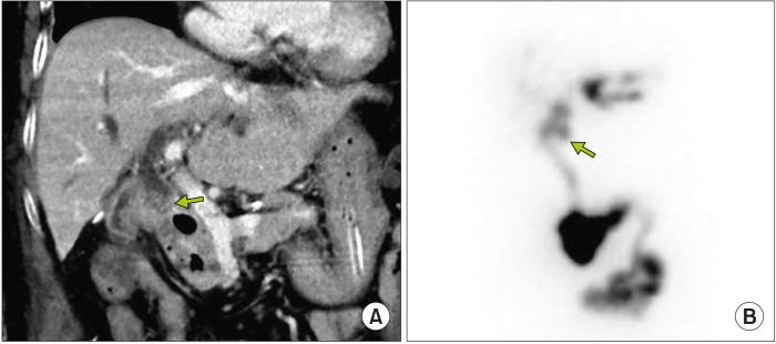 Postoperative findings at two weeks after surgery in Case No. 1. (A) Computed tomography scan shows uneventful drainage of the bile from to proximal common bile duct (CBD) to the jejunal limb. The distal CBD is occluded (arrow). (B) Hepato-biliary scintigraphy shows a normal biliary excretion rate of 92.5% at 90 minutes. The distal CBD is occluded (arrow).