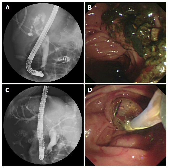 Large stones in the common bile duct were cracked by extracorporeal shock wave lithotripsy (A) and cleared by following endoscopic retrograde cholangiopancreatography (B and C), common bile duct strictures were dilated using a balloon, and passage dilating catheters were used to retrieve the stones (D).