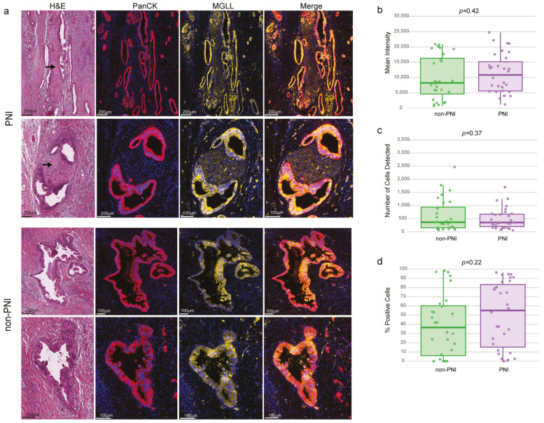 Immunohistochemistry (IHC) for MGLL. (a) Representative histology (H&E staining) images of regions selected to measure immunoreactivity of MGLL in cancer cells in PNI and non-PNI foci. Arrow indicates nerve. IHC double immunofluorescence of morphological regions selected with PanCK and MGLL staining. (b) Mean intensity of MGLL in PanCK-positive regions (PNI and non-PNI foci). (c) Number of cells detected/region. (d) Percentage of cells with positive expression of MGLL. IHC was performed in 8 PDAC samples and quantification of MGLL immunoreactivity performed in 59 regions (31 PNI and 28 non-PNI). Indicated p-values from T-test.