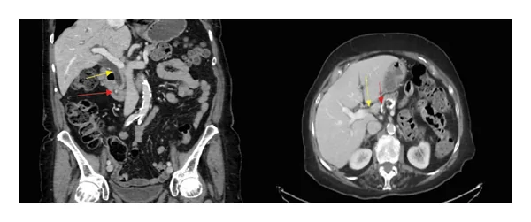 Computed tomography (coronal and axial views) on admission showing a clip obstructing the distal common bile duct (red arrows) and interval worsening of dilation of the common bile duct (up to 15 mm) and intrahepatic biliary ducts (yellow arrows).