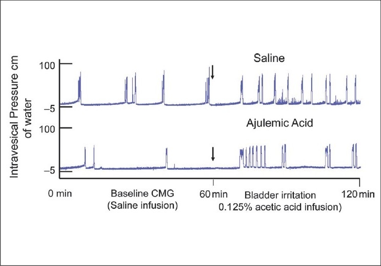 Cystometric effect of mixed CB1/CB2 receptor agonist, ajulemic acid on bladder irritation induced by infusion of acetic acid (0.125%). Rats were pretreated with either saline or ajulemic acid entrapped in liposomes. Baseline cystometry (CMG) was done under saline infusion prior to bladder irritation induced by acetic acid. Activation of local cannabinoid receptors in the bladder blunted the decrease in micturition interval MI induced by acetic acid. Decrease in MI is evident from reduced time interval between the peaks of cystometrogram of saline treated rat relative to rat treated with ajulemic acid. The urodynamic parameter, MI, indirectly represents sensory functions and reduced MI is an integrated response of irritated bladder