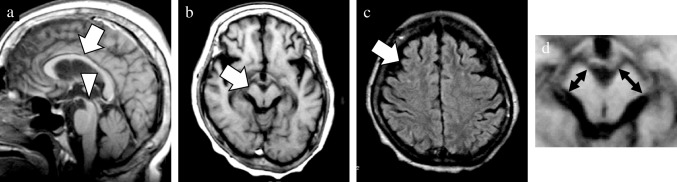 A representative case of radiologically atypical CBD. This 67-year-old female patient obtained an antemortem diagnosis of CBD. MRI was performed four years after the symptom onset. In addition to atrophy of the callosal body (arrow, a), mild midbrain atrophy was also detected on sagittal T1WI (arrowhead, b). In contrast to right dominant asymmetric atrophy of the cerebral peduncle and frontal lobe (arrows, b, c), no obvious SWMH was noted on axial FLAIR image (c). A magnified view was exhibited to emphasize the asymmetry of the short axis in the cerebral peduncles (double sided arrows, d). a, sagittal T1WI; b, axial T1WI; c, axial FLAIR image; CBD, corticobasal degeneration; FLAIR, fluid attenuated inversion recovery; SWMH, subcortical white matter hyperintensity; T1WI, T1-weighted image