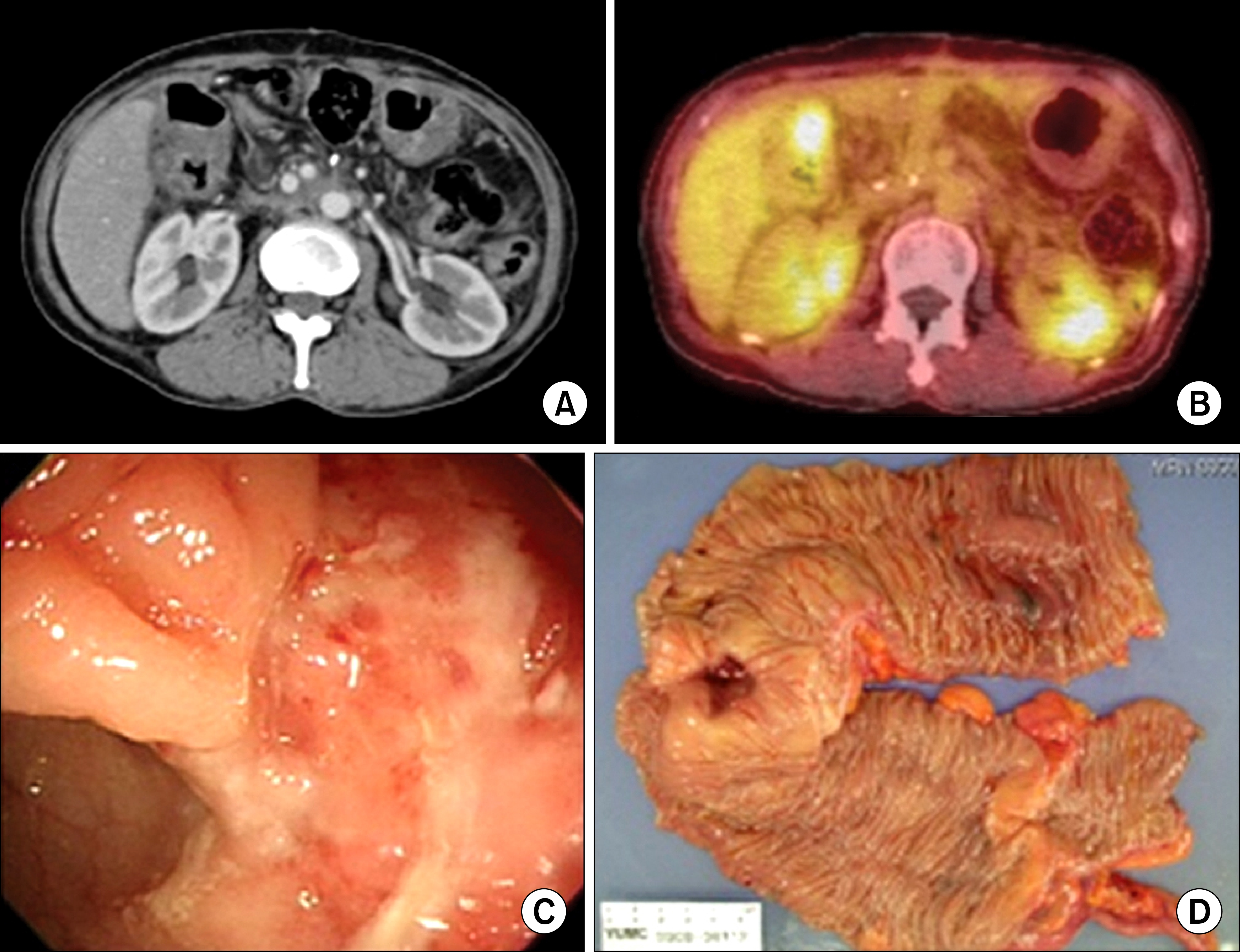 Images of computed tomography (CT), positron emission tomography (PET), colonoscopy and gross specimen for a complication caused by adjuvant radiation therapy. A stricture is shown on the subhepatic colon. (A, CT; B, PET; C, colonoscopy; D, gross specimen).