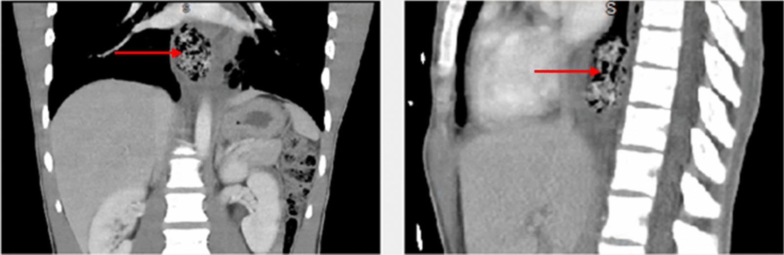 The red arrows on the computed tomography scans demonstrate distal esophageal foreign body with surrounding soft tissue edema