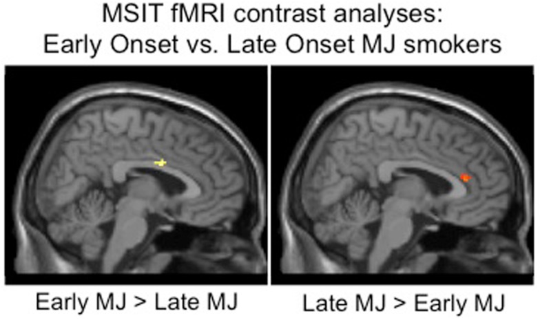 Whole brain inhibitory processing results demonstrating significant differences between adolescent early onset (n = 9) and late adult onset (n = 14) MJ users, early onset MJ users demonstrated increased middle right cingulum and decreased anterior cingulate BOLD response to an inhibitory processing (multisource interference task, MSIT) fMRI task (adapted fromGruber et al., 2012).