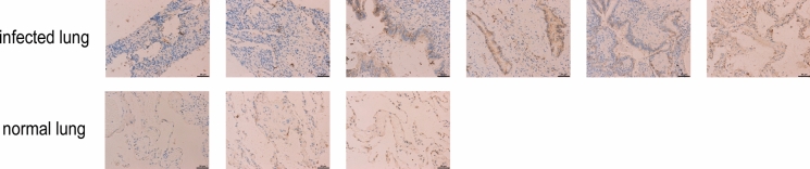 The expression of claudin-4 in pulmonary specimens from clinical patients