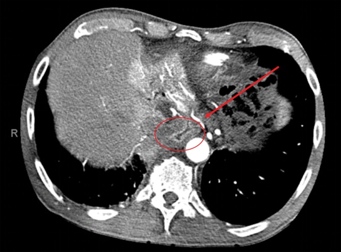 Preoperative CT angiography illustrating the common hepatic artery dividing into the proper hepatic artery, gastroduodenal artery, and right gastric artery (arrow) that is supplying the gastric conduit (circle).