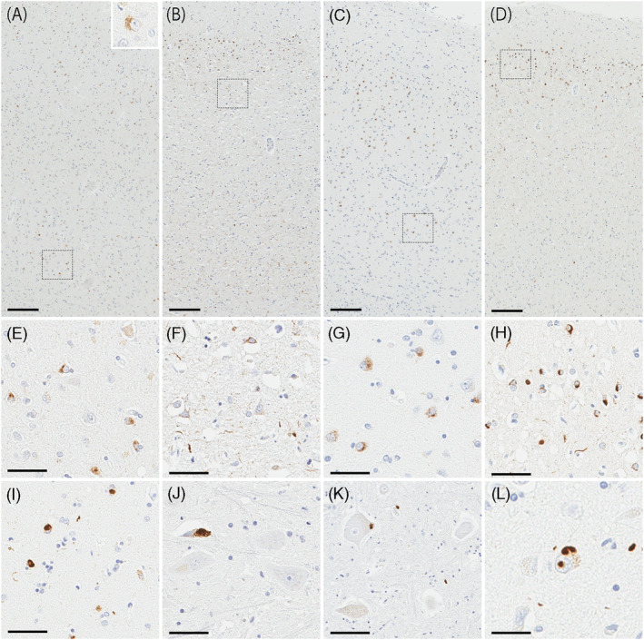 Representative images of TDP‐43 lesions. (A–L) Immunohistochemistry for pTDP‐43. The motor cortex shows abundant TDP‐43 positive neuronal cytoplasmic inclusions (NCI) in all layers. Some cases have diffuse granular NCI (A). In some cases, abundant NCI and dystrophic neurites (DN) are observed in layer II of the motor cortex (B). The superior temporal gyrus shows abundant NCI in all layers (C). In some cases, abundant NCI and DN are observed in layer II of the superior temporal gyrus (D). Boxes in A–D indicate locations of high magnification images in the lesion (E–H). NCI are observed in the motor cortex (E). NCI and dystrophic neurites are observed in the motor cortex (F). NCI are observed in superior temporal gyrus (G). NCI and dystrophic neurites are observed in the motor cortex (D). NCI are observed in the putamen (I), hypoglossal nucleus (J), anterior horn in the spinal cord (K). Neuronal intranuclear inclusion are observed (L). Scale bars: 200 μm in A–D, 50 μm in E–L.